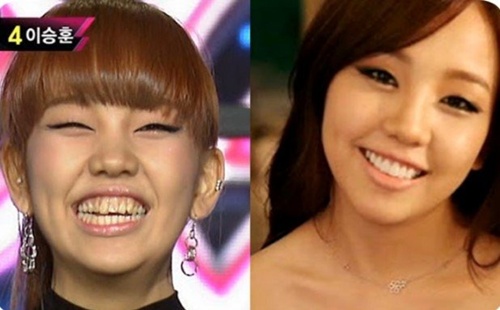 라미네이트로 시술로 이루어진 치아